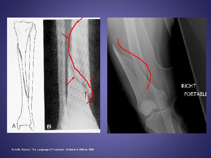 Schultz, Robert, “The Language of Fractures”. Williams & Wilkins 1990 