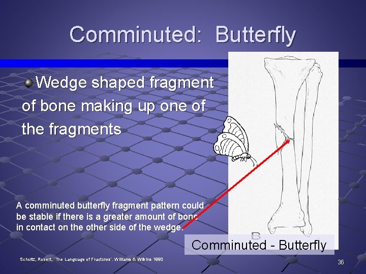 Comminuted: Butterfly Wedge shaped fragment of bone making up one of the fragments A