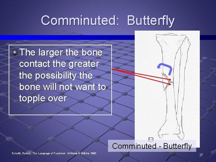 Comminuted: Butterfly The larger the bone contact the greater the possibility the bone will