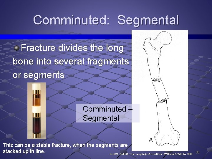 Comminuted: Segmental Fracture divides the long bone into several fragments or segments Comminuted –