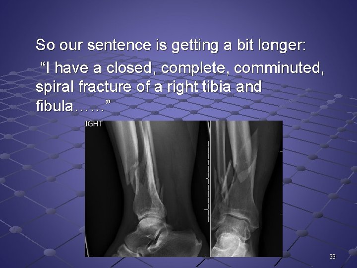 So our sentence is getting a bit longer: “I have a closed, complete, comminuted,