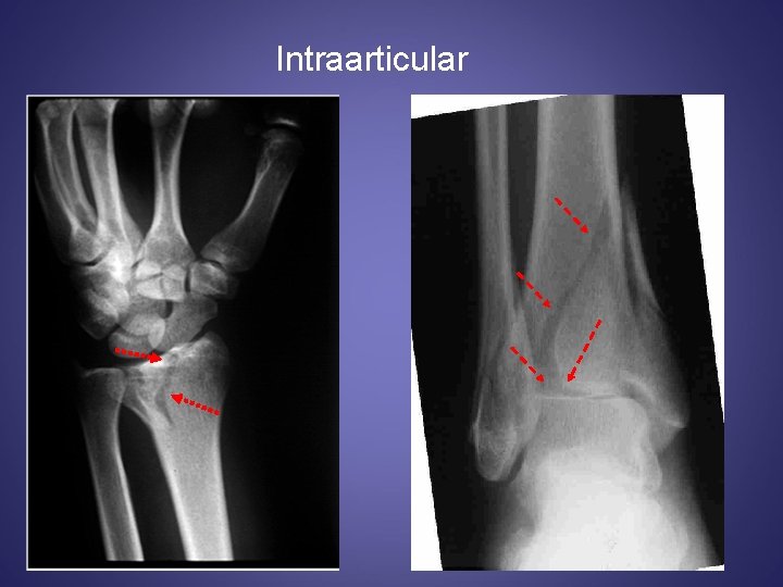 Intraarticular 