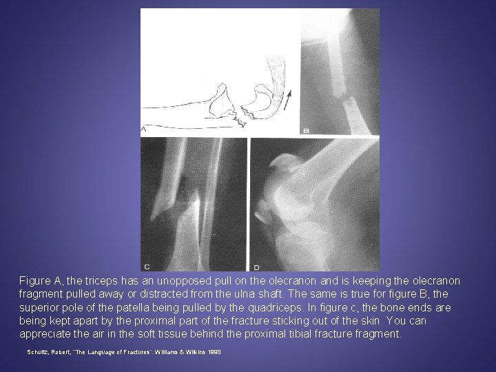 Figure A, the triceps has an unopposed pull on the olecranon and is keeping