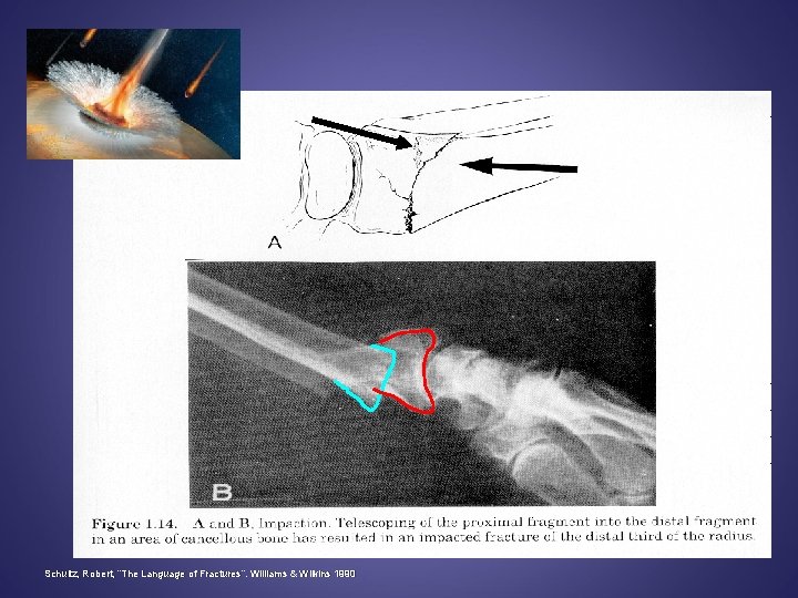 Schultz, Robert, “The Language of Fractures”. Williams & Wilkins 1990 