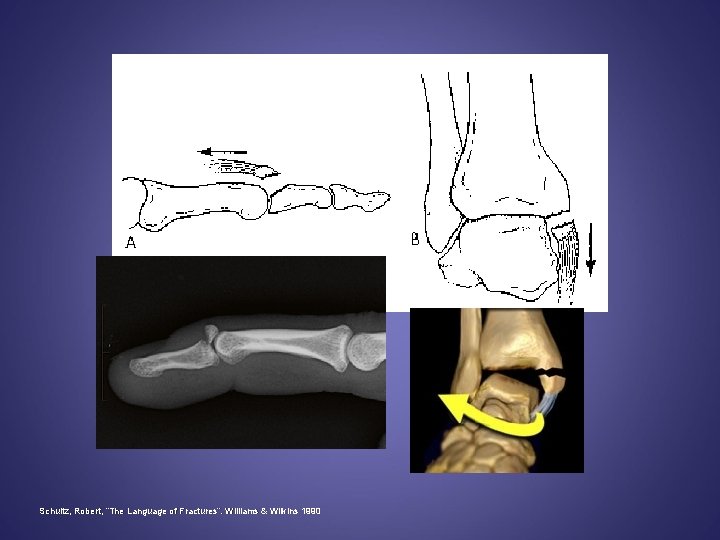 Schultz, Robert, “The Language of Fractures”. Williams & Wilkins 1990 