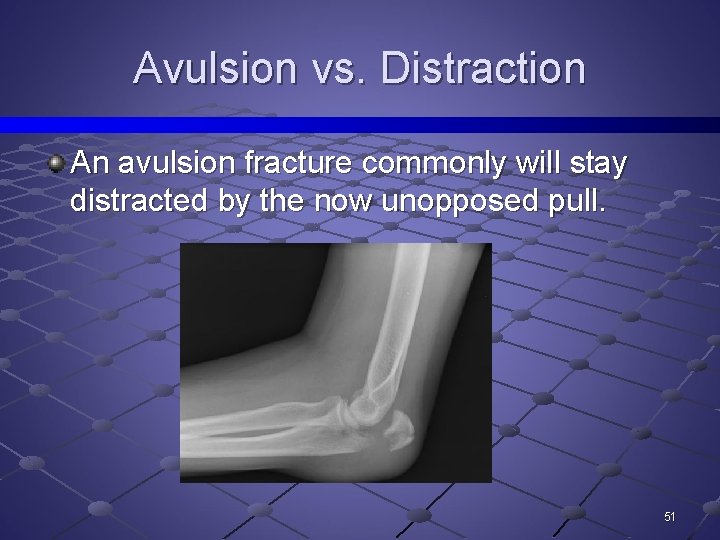 Avulsion vs. Distraction An avulsion fracture commonly will stay distracted by the now unopposed