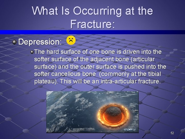 What Is Occurring at the Fracture: Depression: The hard surface of one bone is