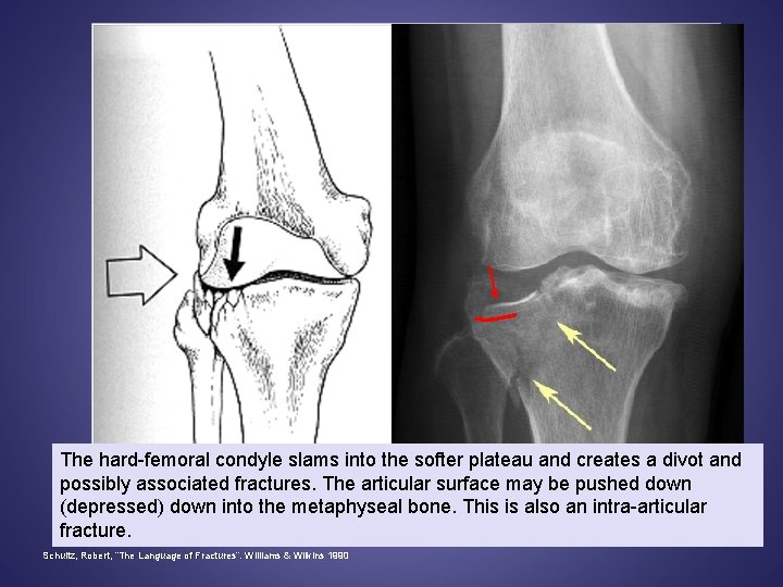 The hard-femoral condyle slams into the softer plateau and creates a divot and possibly