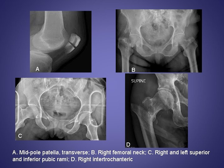 A B C D A. Mid-pole patella, transverse; B. Right femoral neck; C. Right