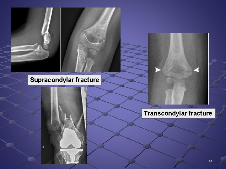 Supracondylar fracture Transcondylar fracture 65 