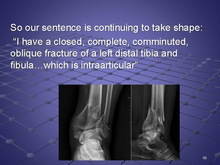 So our sentence is continuing to take shape: “I have a closed, complete, comminuted,