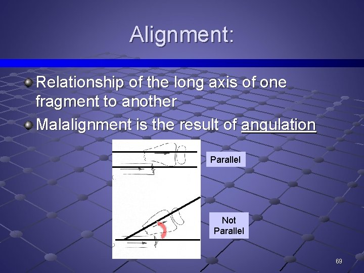 Alignment: Relationship of the long axis of one fragment to another Malalignment is the