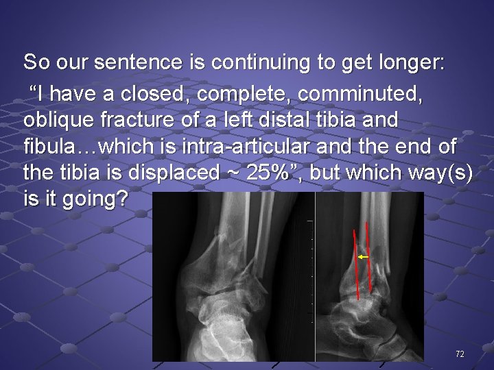 So our sentence is continuing to get longer: “I have a closed, complete, comminuted,