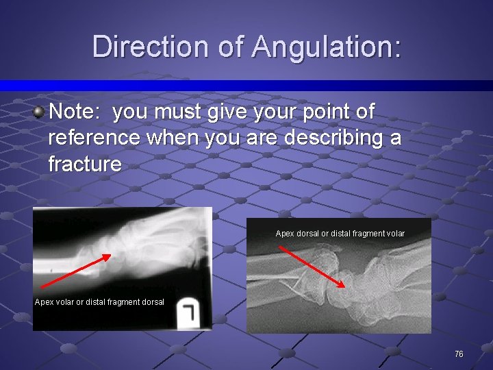 Direction of Angulation: Note: you must give your point of reference when you are