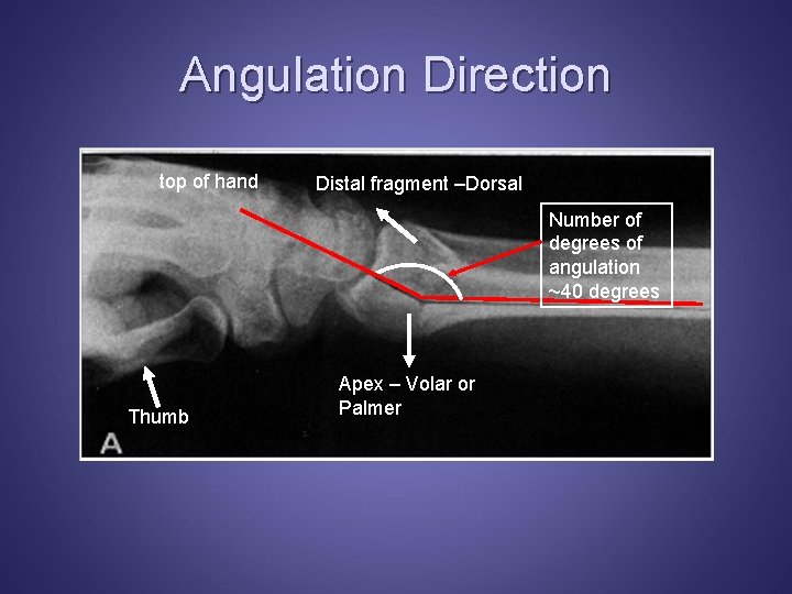 Angulation Direction top of hand Distal fragment –Dorsal Number of degrees of angulation ~40