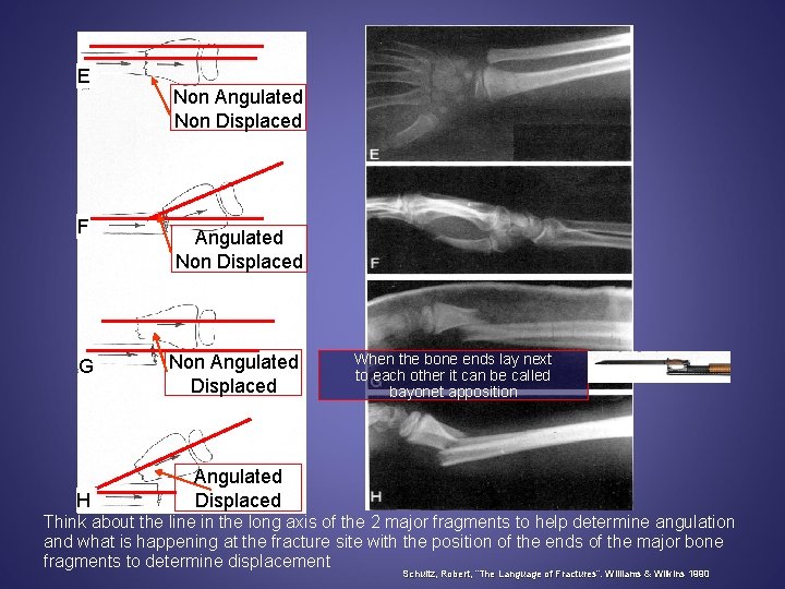 E F G H Non Angulated Non Displaced Non Angulated Displaced When the bone