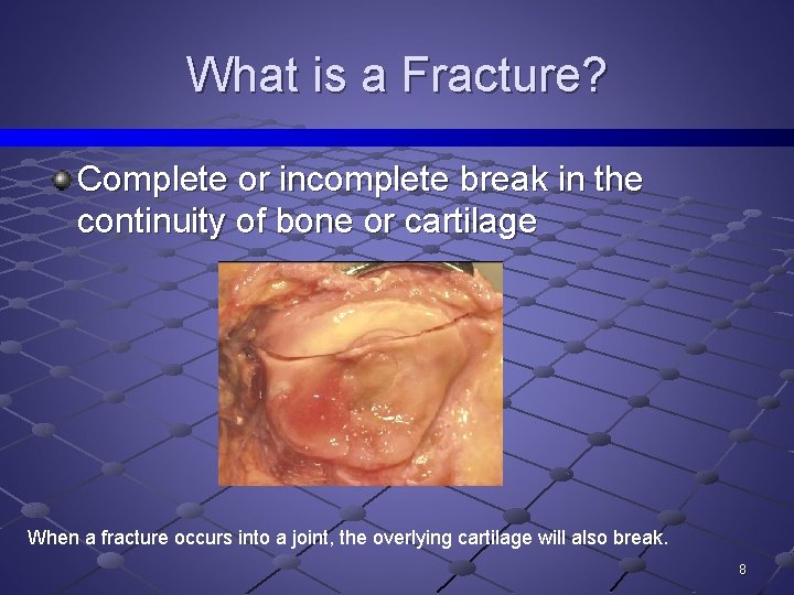 What is a Fracture? Complete or incomplete break in the continuity of bone or