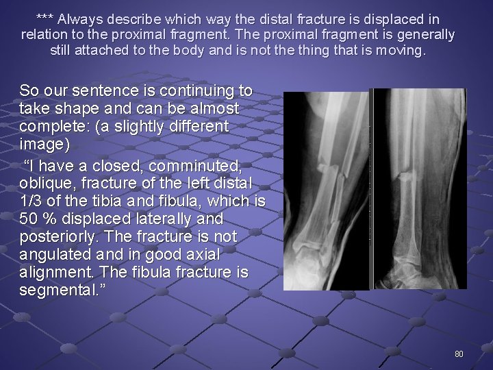 *** Always describe which way the distal fracture is displaced in relation to the