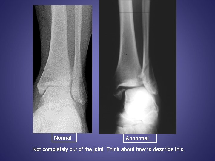Normal Abnormal Not completely out of the joint. Think about how to describe this.