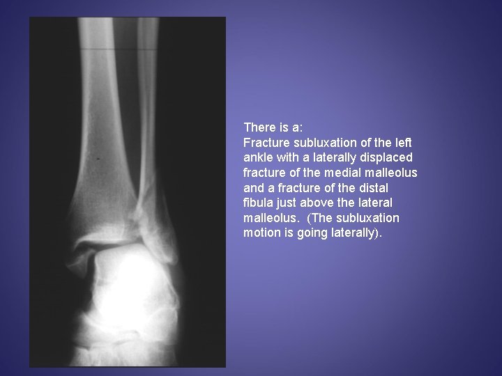 There is a: Fracture subluxation of the left ankle with a laterally displaced fracture