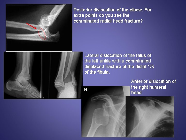 Posterior dislocation of the elbow. For extra points do you see the comminuted radial