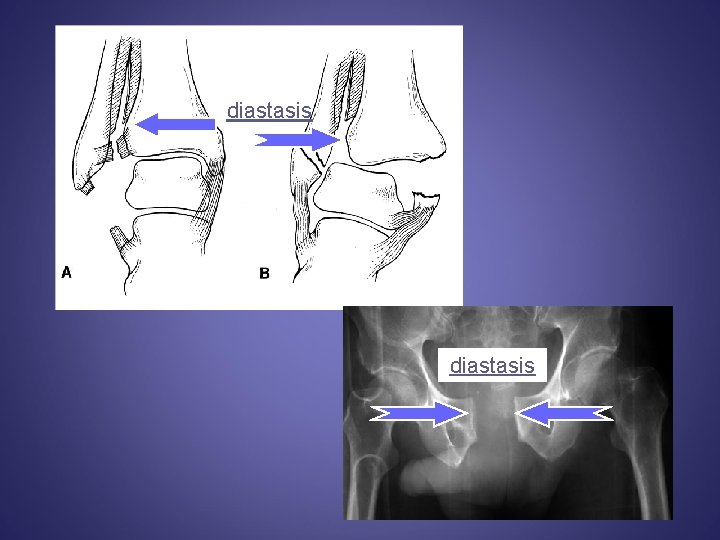 diastasis 