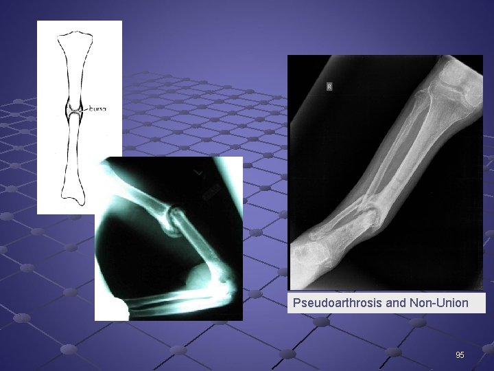 Pseudoarthrosis and Non-Union 95 