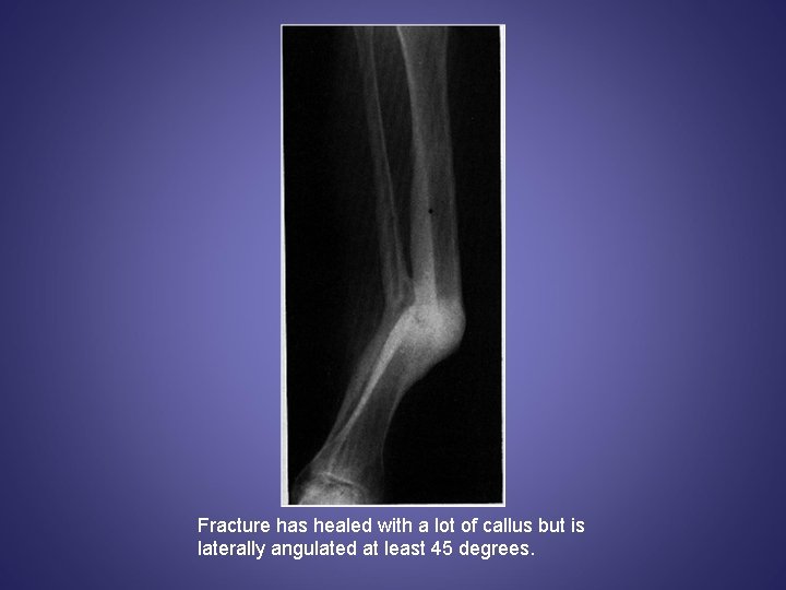 Fracture has healed with a lot of callus but is laterally angulated at least