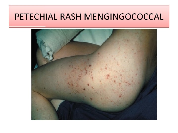 PETECHIAL RASH MENGINGOCOCCAL 