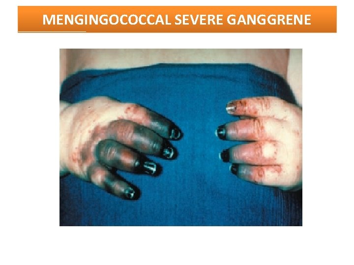 MENGINGOCOCCAL SEVERE GANGGRENE 