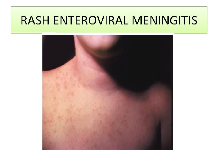 RASH ENTEROVIRAL MENINGITIS 