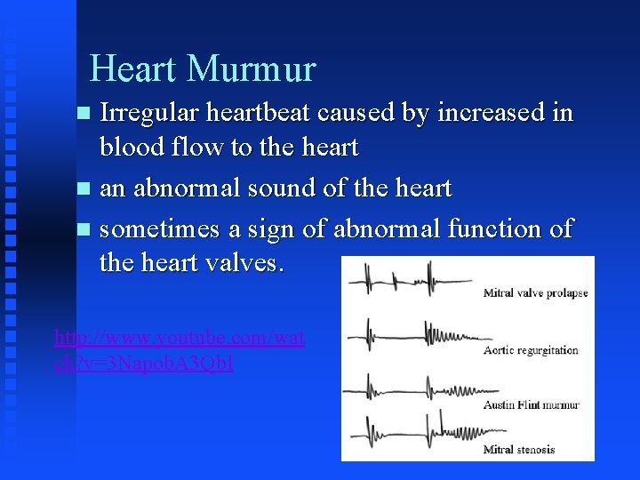 Heart Murmur Irregular heartbeat caused by increased in blood flow to the heart n