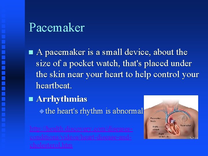 Pacemaker A pacemaker is a small device, about the size of a pocket watch,