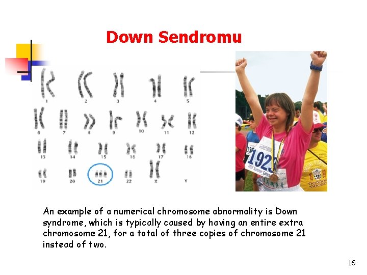 Down Sendromu An example of a numerical chromosome abnormality is Down syndrome, which is