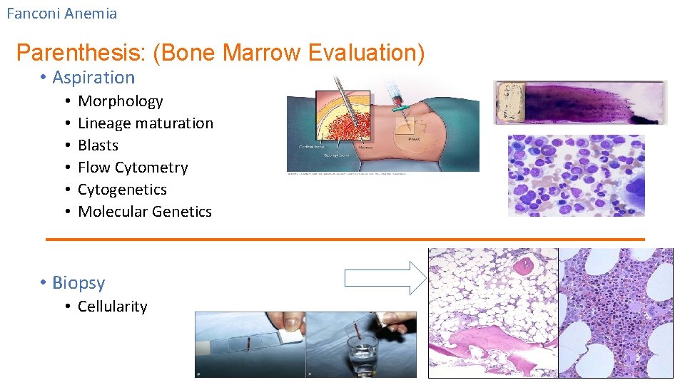 Fanconi Anemia Parenthesis: (Bone Marrow Evaluation) • Aspiration • • • Morphology Lineage maturation