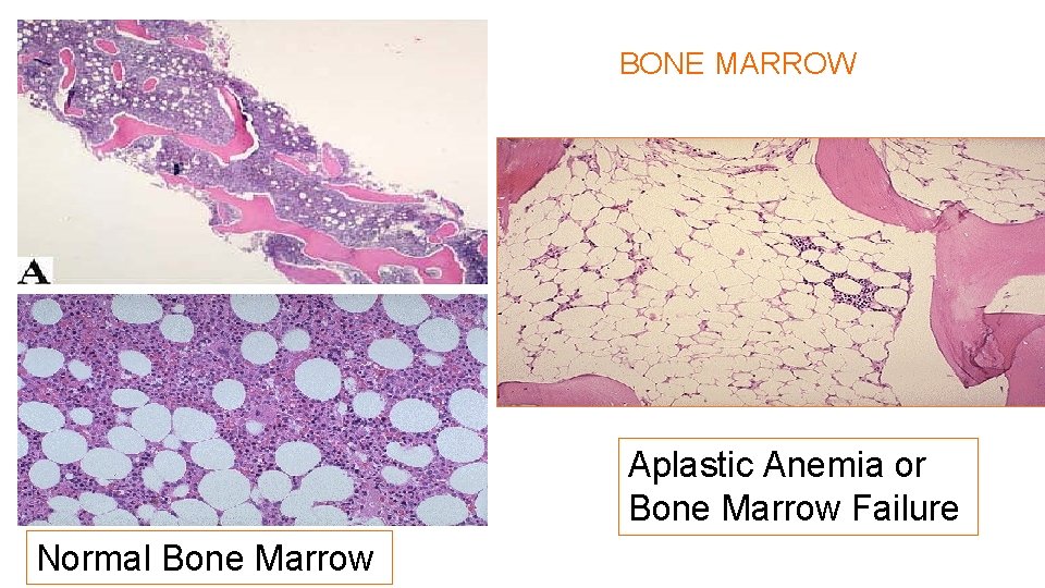 BONE MARROW Aplastic Anemia or Bone Marrow Failure Normal Bone Marrow 