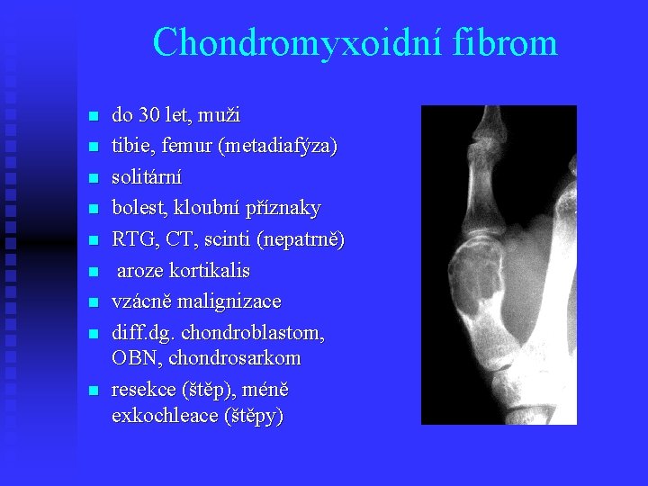 Chondromyxoidní fibrom n n n n n do 30 let, muži tibie, femur (metadiafýza)