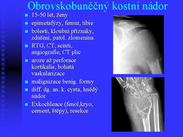 Obrovskobuněčný kostní nádor n n n n 15 -50 let, ženy epimetafýzy, femur, tibie