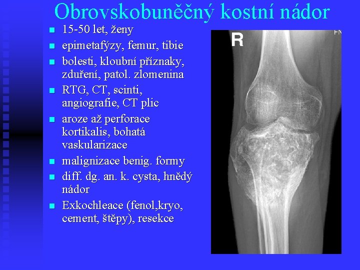 Obrovskobuněčný kostní nádor n n n n 15 -50 let, ženy epimetafýzy, femur, tibie