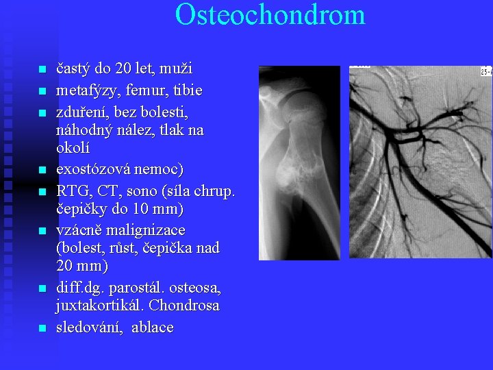 Osteochondrom n n n n častý do 20 let, muži metafýzy, femur, tibie zduření,