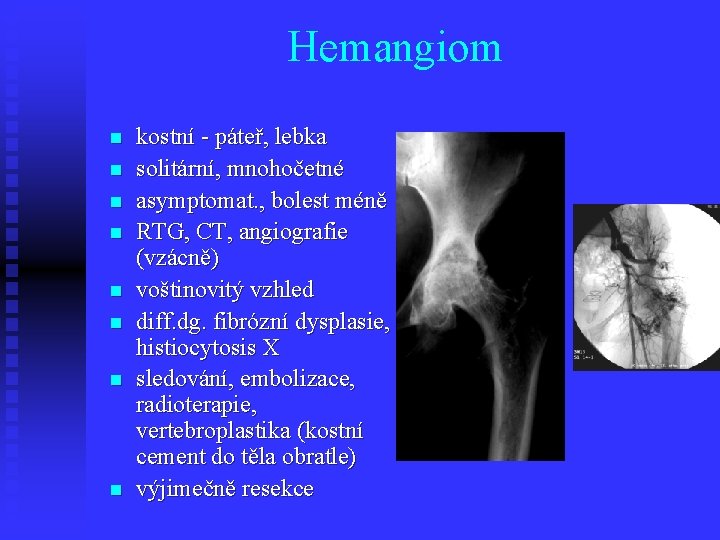 Hemangiom n n n n kostní - páteř, lebka solitární, mnohočetné asymptomat. , bolest