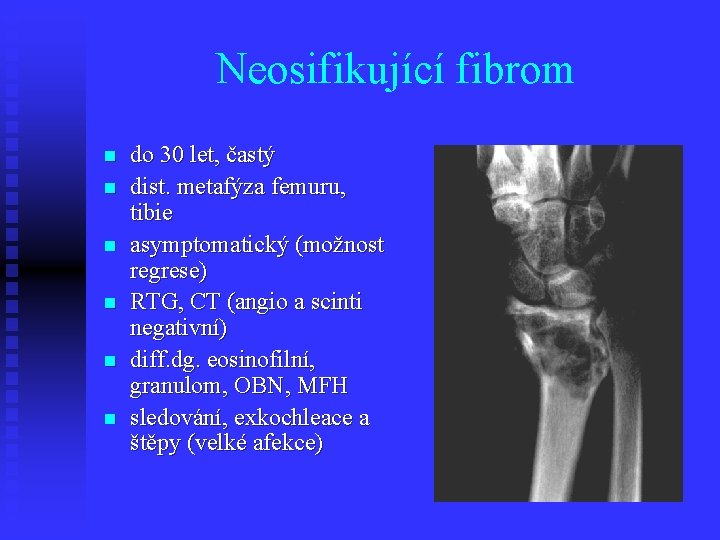 Neosifikující fibrom n n n do 30 let, častý dist. metafýza femuru, tibie asymptomatický