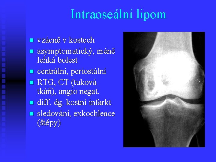 Intraoseální lipom n n n vzácně v kostech asymptomatický, méně lehká bolest centrální, periostální