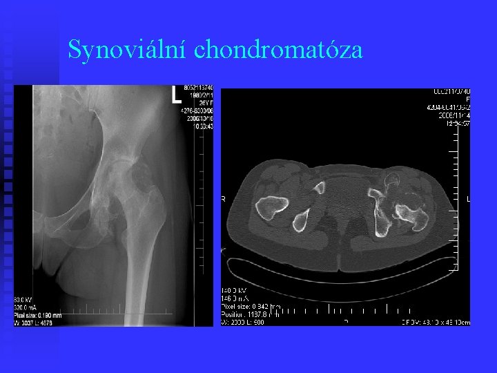 Synoviální chondromatóza 