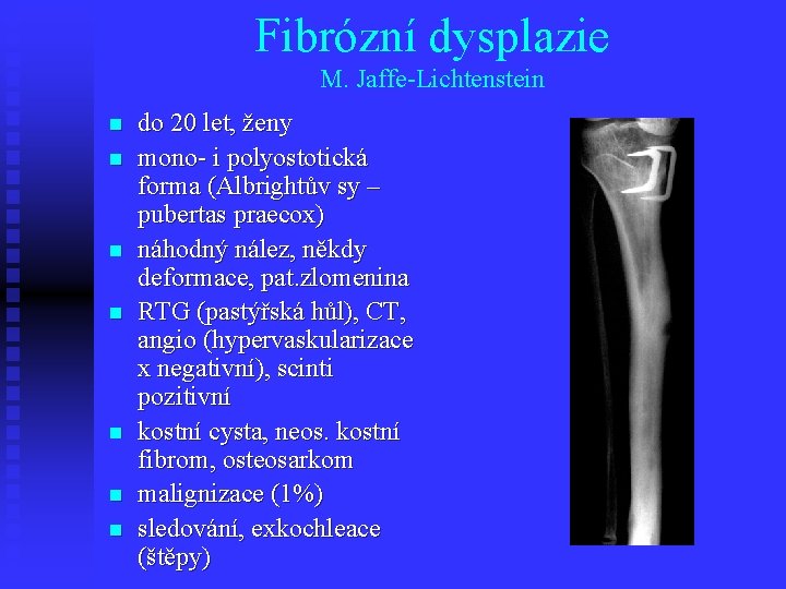 Fibrózní dysplazie M. Jaffe-Lichtenstein n n n do 20 let, ženy mono- i polyostotická