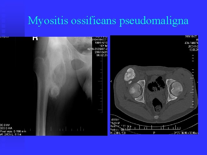 Myositis ossificans pseudomaligna 