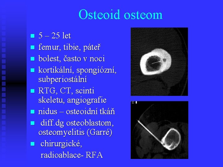 Osteoid osteom n n n n 5 – 25 let femur, tibie, páteř bolest,