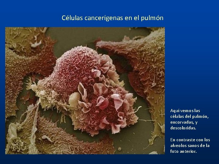 Células cancerígenas en el pulmón Aquí vemos las células del pulmón, encorvadas, y descoloridas.