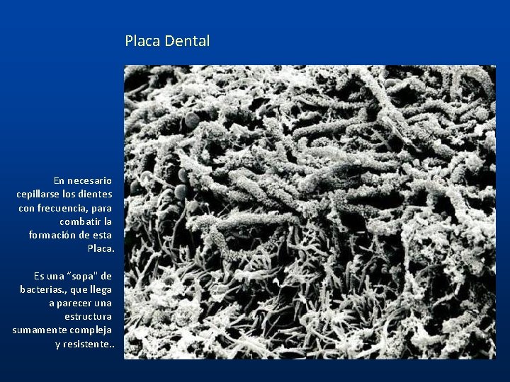 Placa Dental En necesario cepillarse los dientes con frecuencia, para combatir la formación de