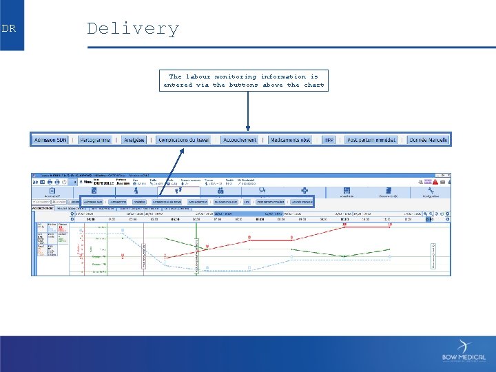 DR Delivery The labour monitoring information is entered via the buttons above the chart